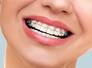 Коррекция зубов брекетами