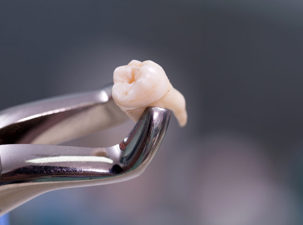 Удаление зубов без боли