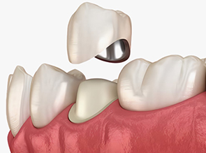Металлокерамические коронки